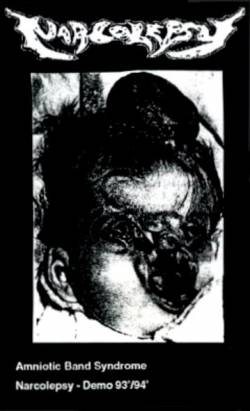 Amniotic Band Syndrome